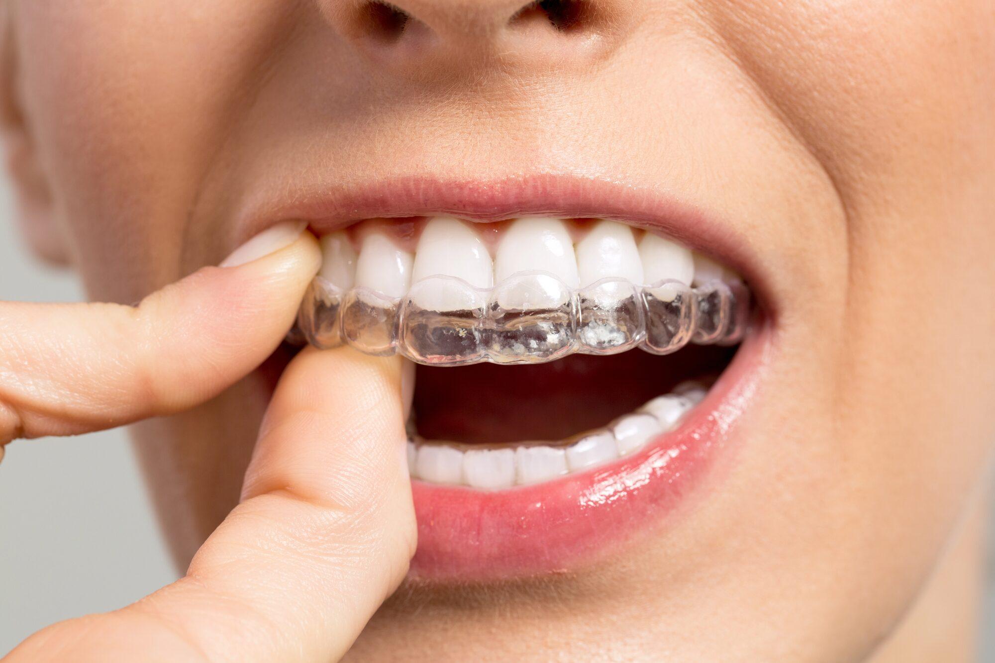 Transparente Aligner