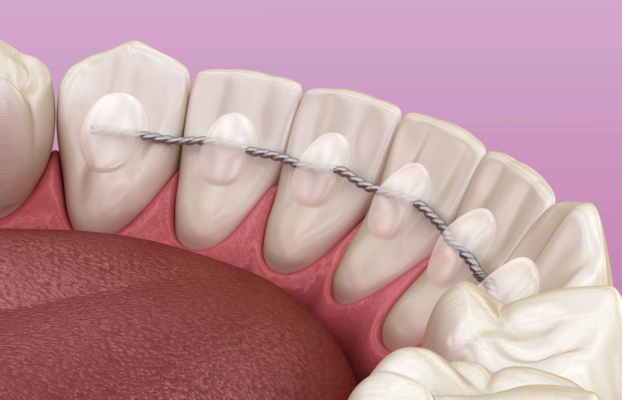 Retainer